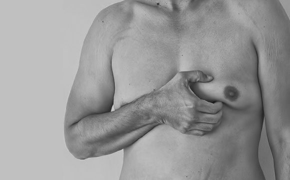 Gynecomastia