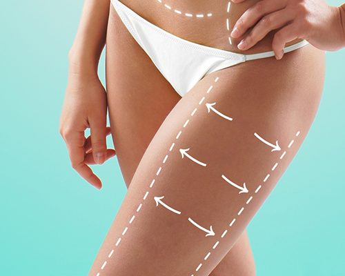 İnfrasonik Liposuction