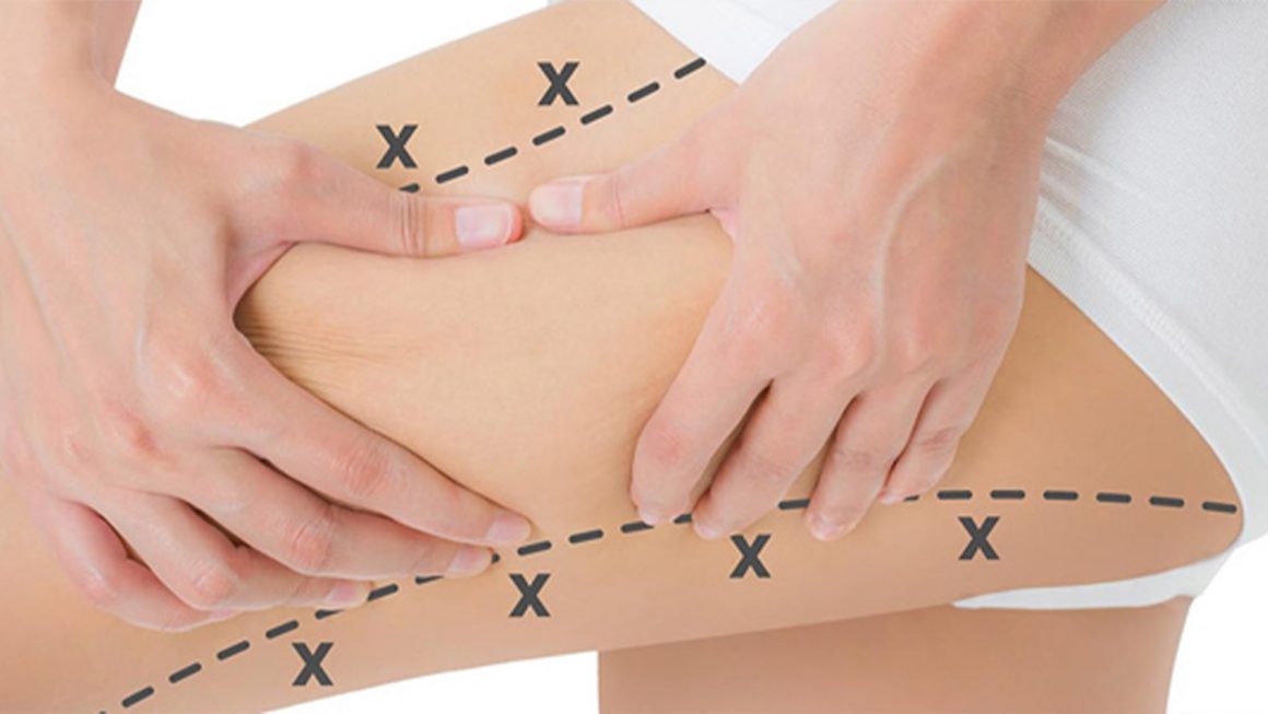 Lazer Liposuction