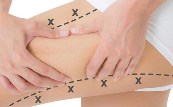 Lazer Liposuction