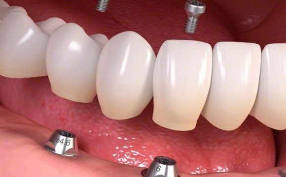implantlar