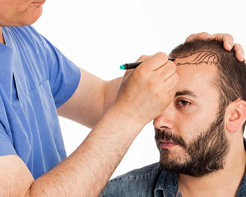 FUE Hair Transplantation